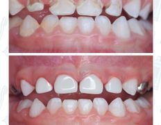 Стоматологический центр Kids Smile (Кидс Смайл), Примеры работ - фото 5