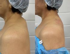 Клиника красоты и здоровья ЮТА, Липосакция холки - фото 2