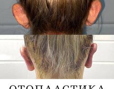 Клиника красоты и здоровья ЮТА, Отопластика - фото 20