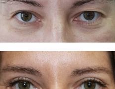 Клиника красоты и здоровья ЮТА, Блефаропластика - фото 12