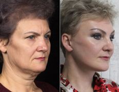 null Клиника пластической хирургии доктора Кобландина, Примеры работ - фото 4