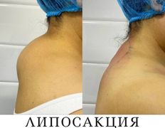 Клиника красоты и здоровья ЮТА, Липосакция холки - фото 14