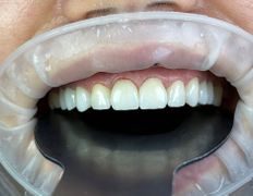 Стоматологический центр SDS dr. Bayram-Ali (Смайл Дизайн Студия), Примеры работ - фото 5