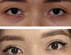 Клиника пластической хирургии и косметологии Надиалан Aesthetic (Надиалан Эстетик), Блефаропластика - фото 2