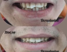 Стоматология Dental & Beauty Clinic Айнабулак (Дентал энд Бьюти Клиник Айнабулак), Примеры работ - фото 6