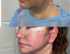 Клиника красоты и здоровья ЮТА, Подтяжка лица и шеи - фото 15