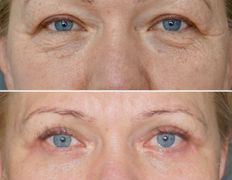 Клиника красоты и здоровья ЮТА, Блефаропластика - фото 18