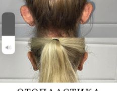 Клиника красоты и здоровья ЮТА, Отопластика - фото 14