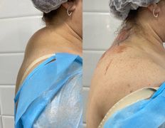 Клиника красоты и здоровья ЮТА, Липосакция холки - фото 10