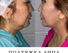 Клиника красоты и здоровья ЮТА, Подтяжка лица и шеи - фото 5