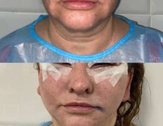 Клиника красоты и здоровья ЮТА, Подтяжка лица и шеи - фото 16