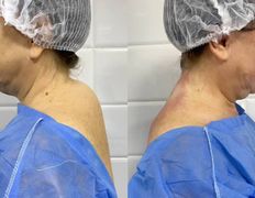 Клиника красоты и здоровья ЮТА, Липосакция холки - фото 3