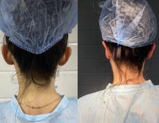 Клиника красоты и здоровья ЮТА, Отопластика - фото 7