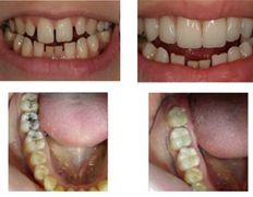 Стоматология Dental & Beauty Clinic Айнабулак (Дентал энд Бьюти Клиник Айнабулак), Примеры работ - фото 13