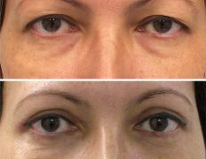 Клиника красоты и здоровья ЮТА, Блефаропластика - фото 9