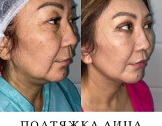 Клиника красоты и здоровья ЮТА, Подтяжка лица и шеи - фото 6