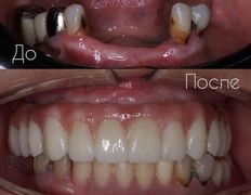 Стоматология One Dent (Уан Дент), Примеры работ - фото 2