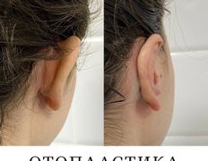 Клиника красоты и здоровья ЮТА, Отопластика - фото 16