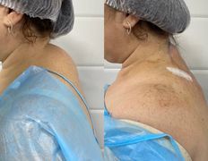 Клиника красоты и здоровья ЮТА, Липосакция холки - фото 9