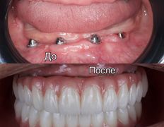 Стоматология One Dent (Уан Дент), Примеры работ - фото 1