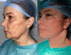 Клиника красоты и здоровья ЮТА, Подтяжка лица и шеи - фото 8