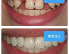 Стоматология Bas dent (Бас дент), Примеры работ - фото 2