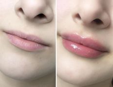 Клиника красоты и здоровья ЮТА, Увеличение губ - фото 2