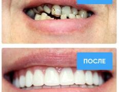 Стоматология Bas dent (Бас дент), Примеры работ - фото 3