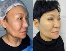Клиника красоты и здоровья ЮТА, Подтяжка лица и шеи - фото 3
