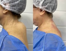 Клиника красоты и здоровья ЮТА, Липосакция холки - фото 4