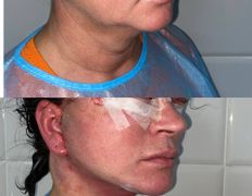 Клиника красоты и здоровья ЮТА, Подтяжка лица и шеи - фото 20