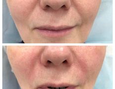 Клиника красоты и здоровья ЮТА, Коррекция носогубных морщин - фото 5