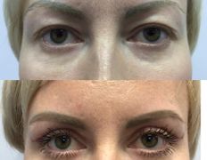 Клиника красоты и здоровья ЮТА, Блефаропластика - фото 1