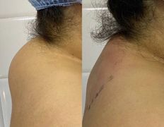 Клиника красоты и здоровья ЮТА, Липосакция холки - фото 11