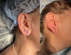 Клиника красоты и здоровья ЮТА, Отопластика - фото 11