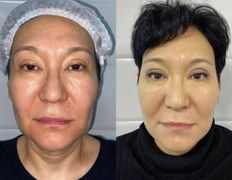 Клиника красоты и здоровья ЮТА, Подтяжка лица и шеи - фото 4
