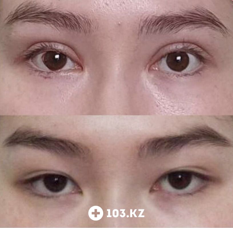 Блефаропластика Клиника пластической хирургии и косметологии «Надиалан Aesthetic (Надиалан Эстетик)» - фото 1660787