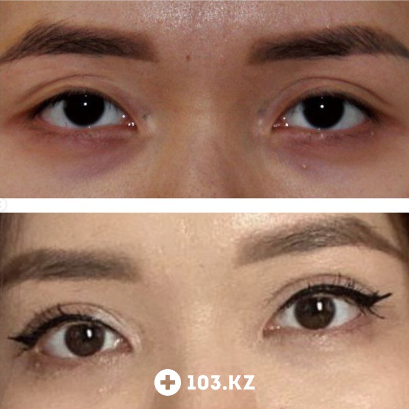 Блефаропластика Клиника пластической хирургии и косметологии «Надиалан Aesthetic (Надиалан Эстетик)» - фото 1660790