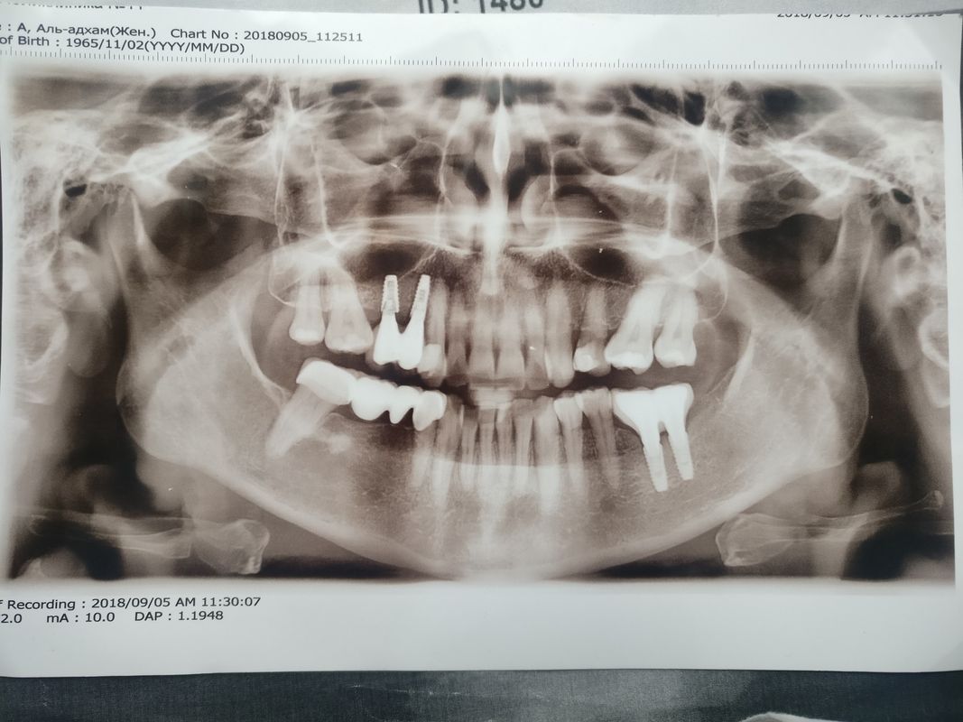 Примеры работ Стоматологический кабинет «Айнабулак Дент» - фото 1595753