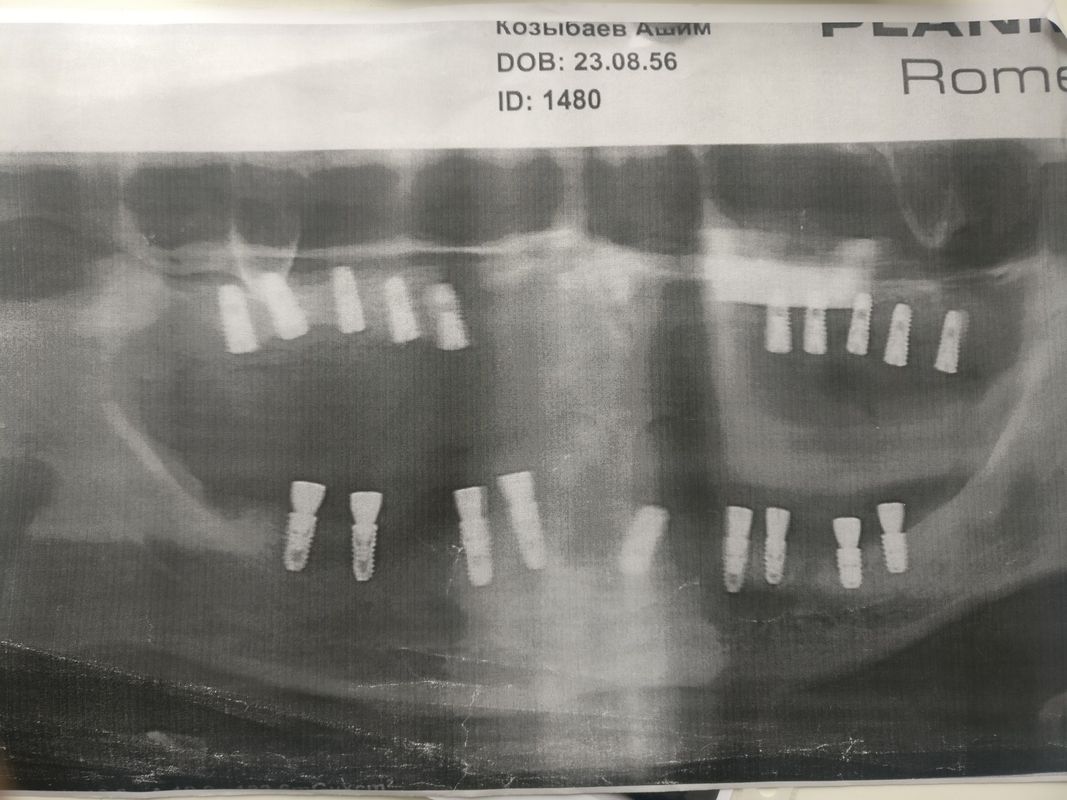 Примеры работ Стоматологический кабинет «Айнабулак Дент» - фото 1595763